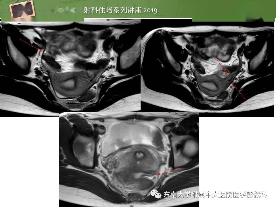 子宮詳細解剖及磁共振信號分析