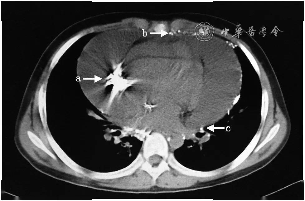 信建峰原发孤立性乳糜性心包积液43例临床特点分析