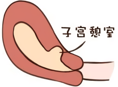 子宫瘢痕憩室二