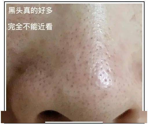 黑头|这张脸，我看了就想吐