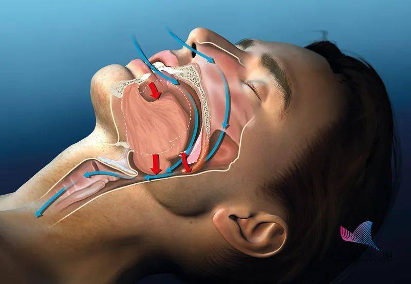 为什么晚上打呼噜会突然被自己憋醒?这是病,得治!
