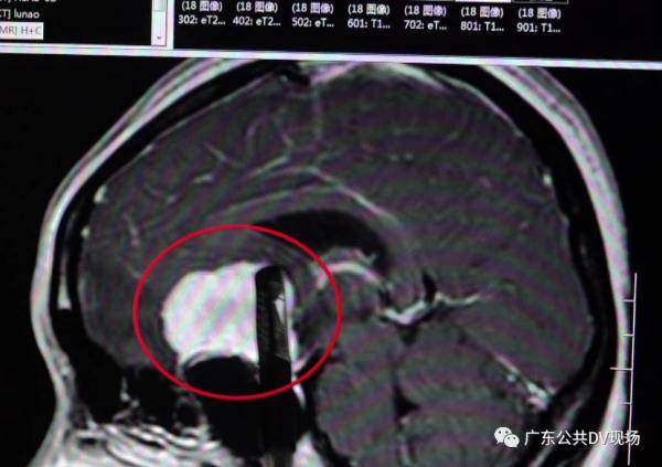 肿瘤|女子视力模糊误以为上火，没想到出大问题了
