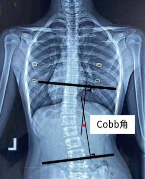 角度|简单辨别脊柱侧弯，避免孩子走“弯”路！