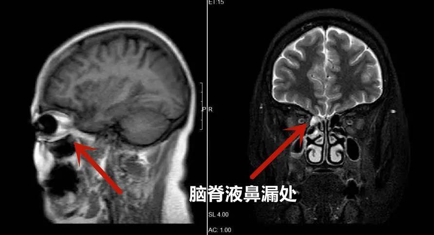 惠州一女性感冒多月以为流 鼻涕 实则脑脊液漏了 阿姨