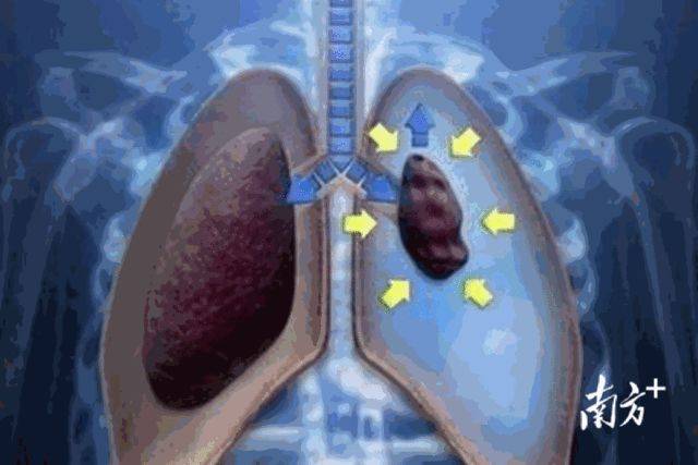 潘裕国|67岁阿婆自行针灸，却针断腹中！医生：擅自针灸有风险