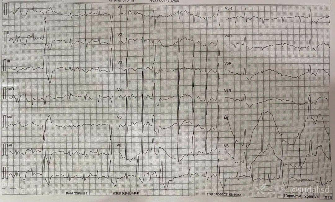 心电图如下:查体:血压 125/75 mmhg,心率 125 次/分,律绝对不齐,心音