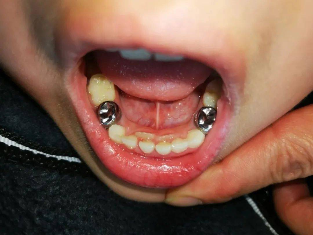 就会一起并排留在口腔中,就导致了双排牙,专业上称为乳牙滞留