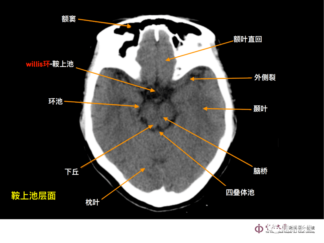 头颅CT解剖图谱图片