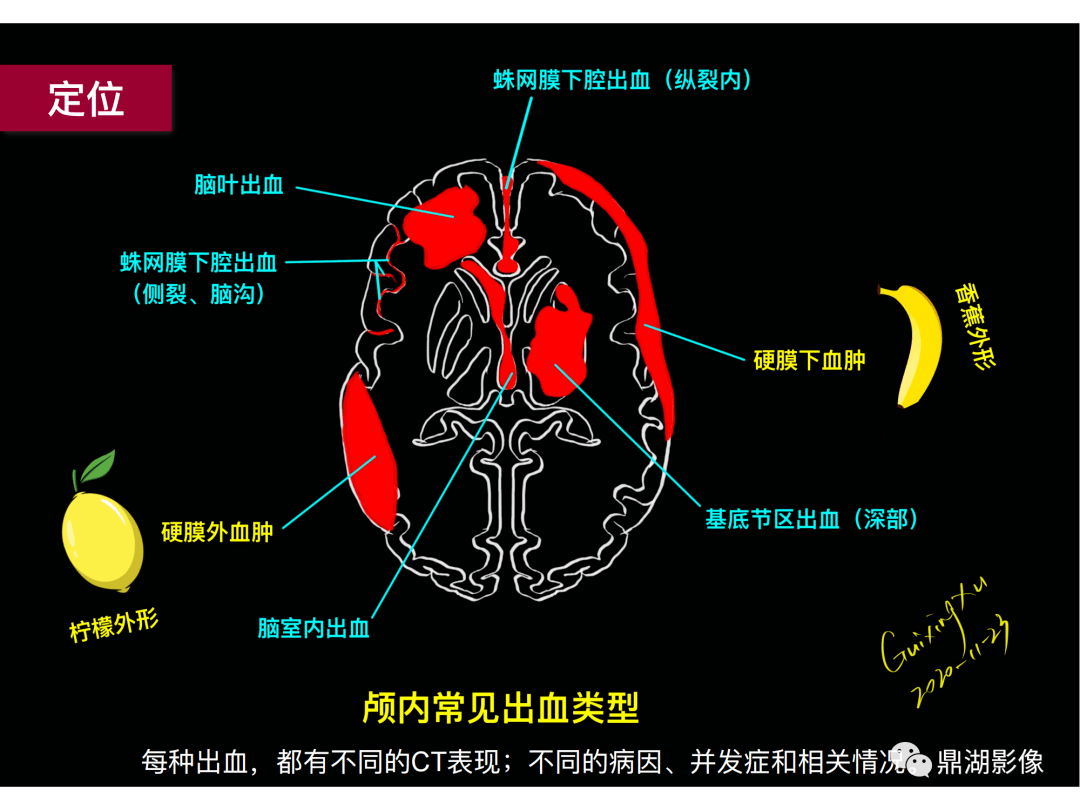 超实用急诊头颅ct3b阅片法