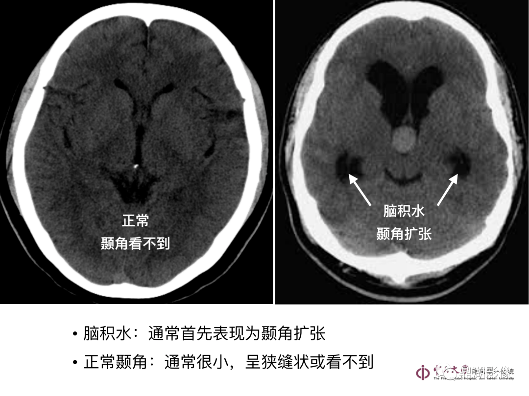 急诊头颅ct