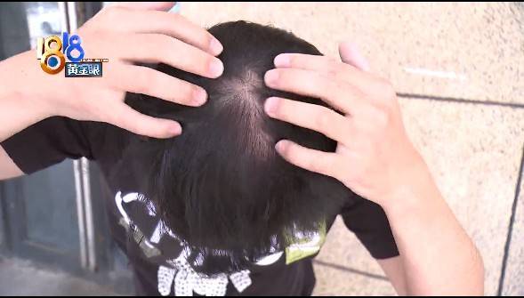 效果|90后“新生植发” 两年后“又见稀疏”