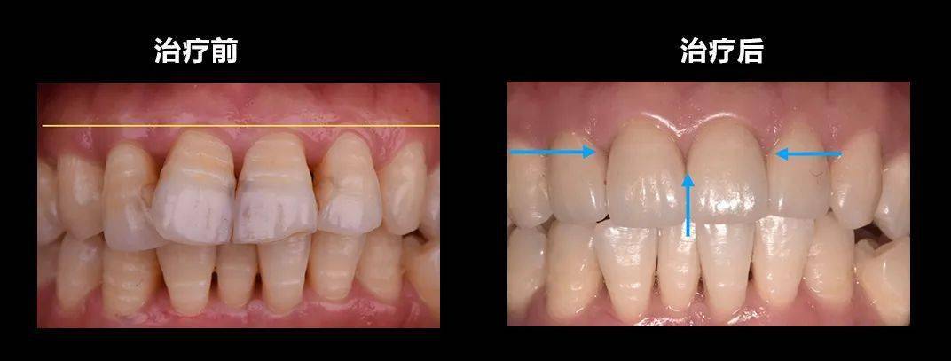 瑞尔病例报告第35期:牙齿前突表面有条纹,但不想正畸怎么办?