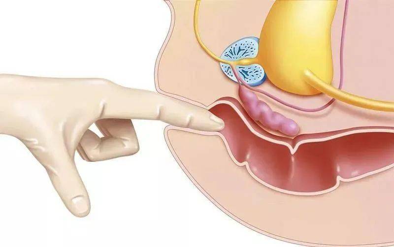 ①擴肛法:是通過手指戴上外科手套放到肛門裡,擴開櫛膜帶(肛梳區),它