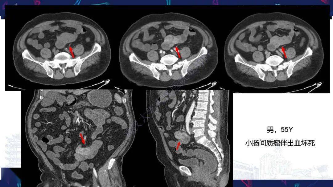 直肠胃肠道间质瘤影像诊断