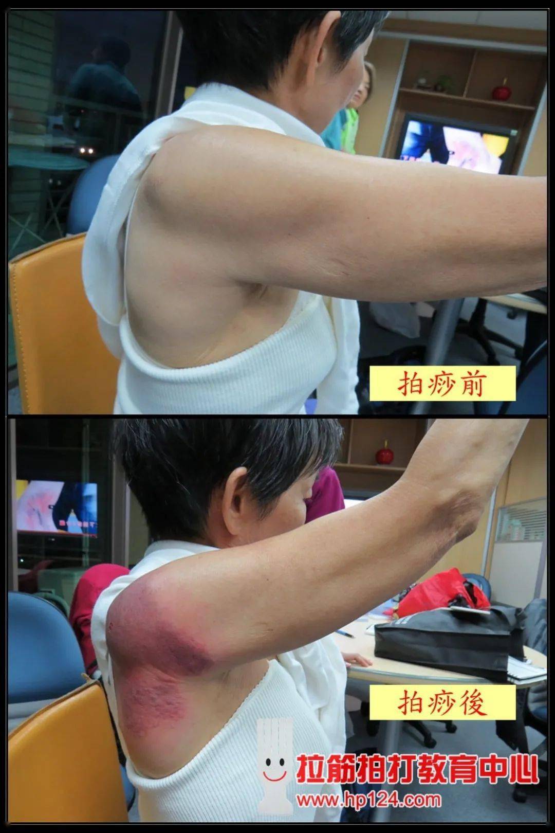 改善五十肩那简单,在课程中会以「拉筋拍打神奇效果」为题,先作一完整