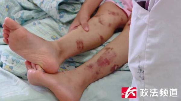 西西|心疼！外婆善意之举，竟致7岁外孙女全身长满水疱