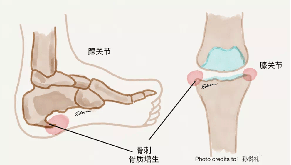 骨刺,醫學術語是骨疣,是關節因種種原因造成軟骨的磨損,破壞,並促成