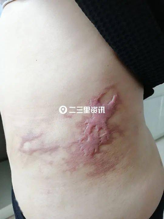 头条女子抽脂手术后出现瘢痕维权难瑞鑫医美对方体质原因导致