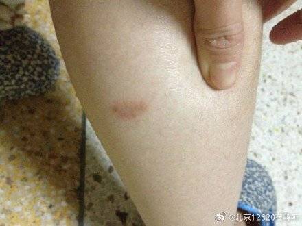 障碍|什么是神经性皮炎？