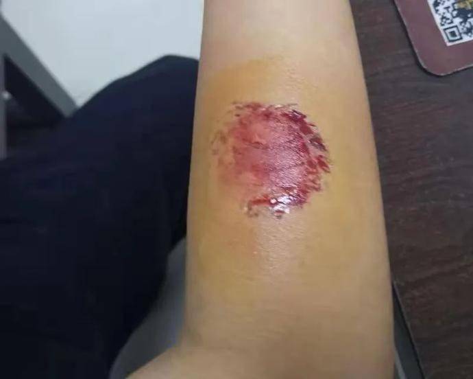 伤口很大,牙印很深看着都觉得很疼陈泽楷在医院简单处理了伤口后便