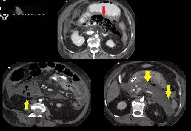 精選病例:典型的急性壞死性胰腺炎
