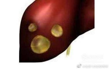 体检|肝囊肿小于10cm且没症状不必太担心