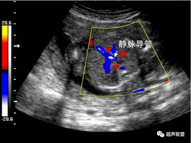 胎儿静脉导管超声图片图片