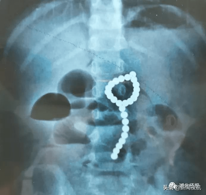 气道|又是它！4岁孩童以为是糖，一口气吞下26颗