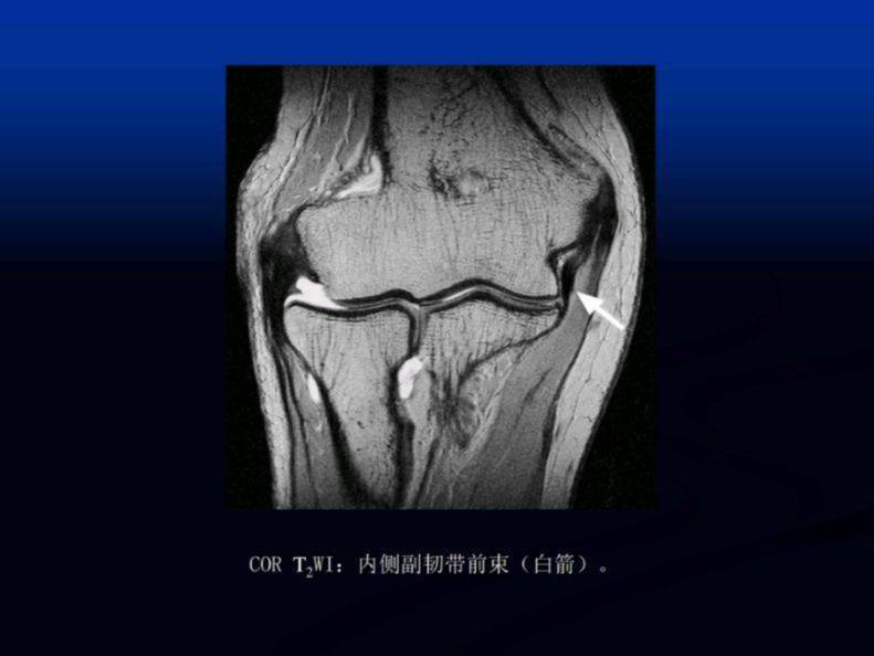 肘关节影像解剖及常见病变mr表现