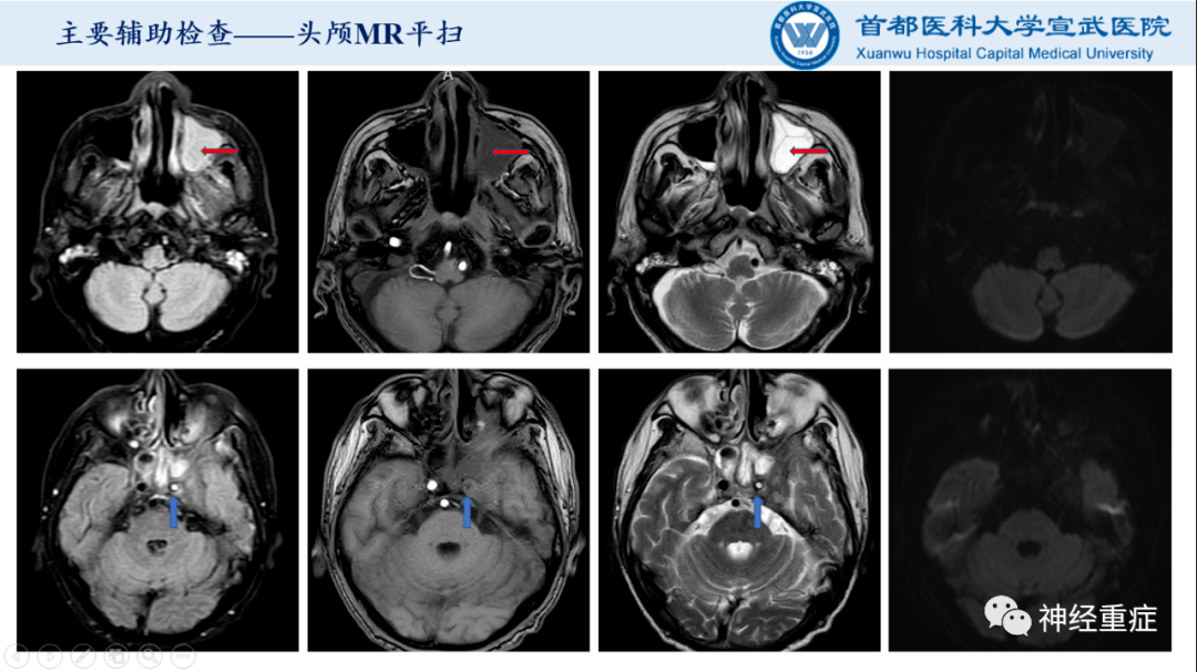 神经急诊病例:海绵窦疾病_鼻窦