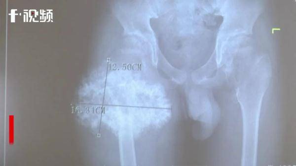 肿瘤|注意！这种病具有遗传性，家长需警惕