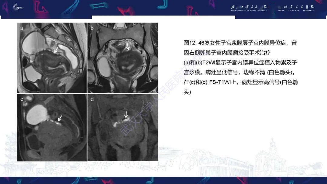 子宫内膜异位症mri诊断