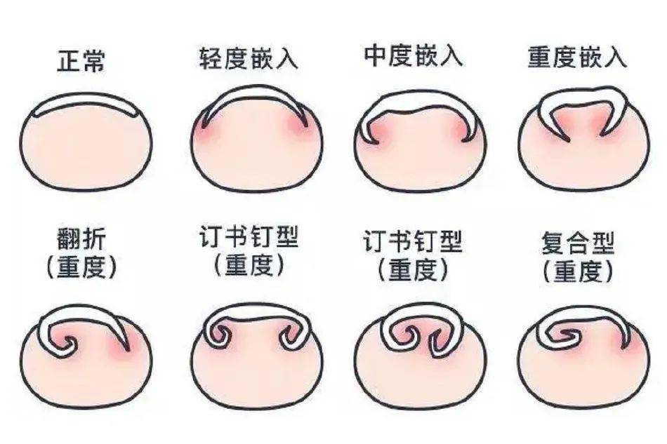 双立人|用了20多年才知道，指甲剪加上这个小机关，就能让指甲从此不再乱「飞」！