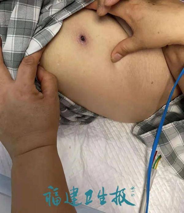 阿姨|可怕！厦门两市民高烧不退，核酸阴性！医生一查竟发现…