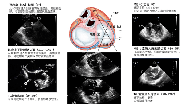 围术期tee应重点评估三尖瓣瓣环的扩张,变形程度,右心室的大小,右室壁