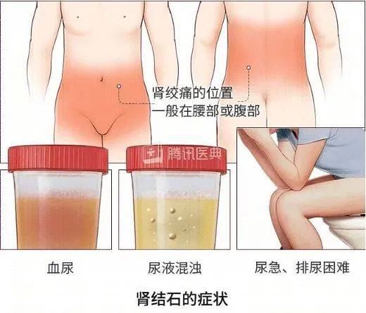 劉佳毅|從來沒痛過的結石，竟把我的腎臟搞壞了