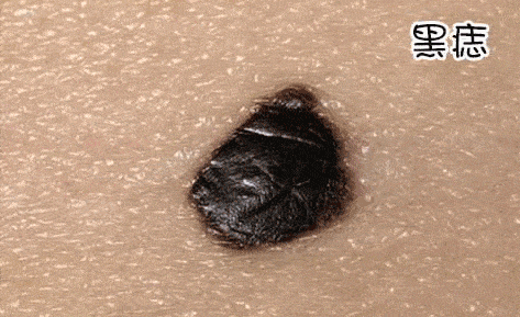 蜘蛛痣,血痣,黑痣手掌心泛红,手掌边缘泛红测测你的肝还好吗?