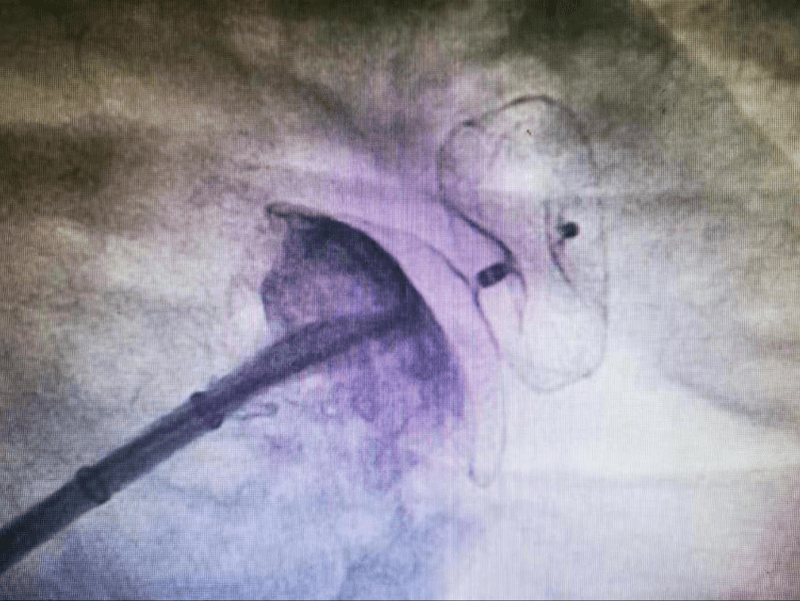 左心|多年房颤患者突发卒中、出血，双管齐下解决房颤血栓两大难题