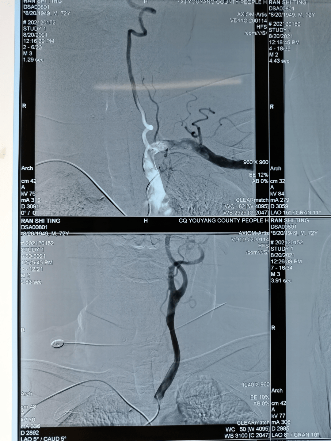 腦血管造影經橈左椎動脈造影經橈右椎動脈造影經橈頸動脈造影經橈頸