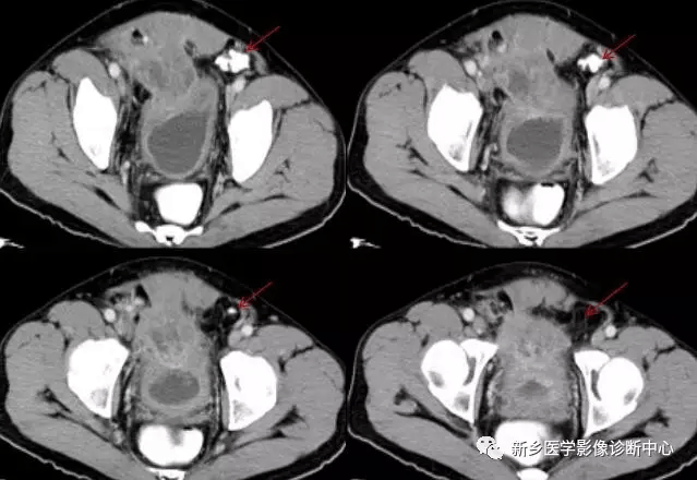 弹簧|图解21种腹部疼痛原因