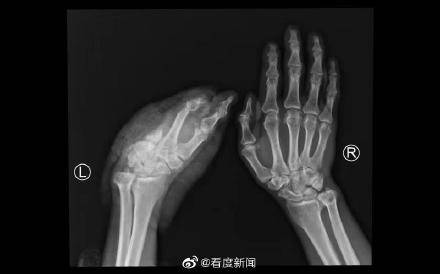 手术|四川运用疫苗冷链技术成功实施断掌再植手术