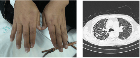 壁不可复原;再进一步发展,肺泡结构完全损害,形成广泛的无功能的蜂窝