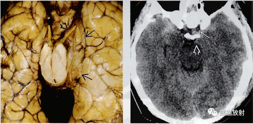 轴位ct平扫:大脑镰下疝,左侧脑挫伤大体病理:多发脑挫伤,大脑镰下疝