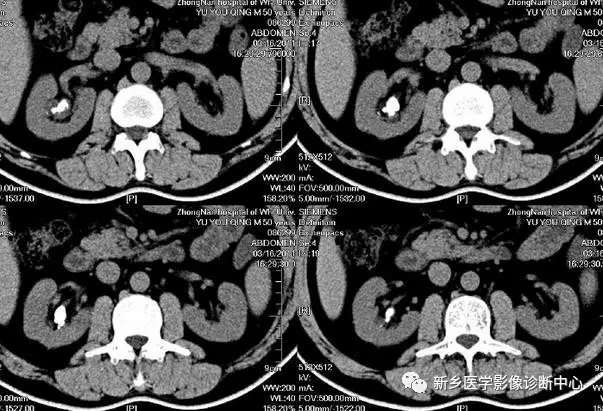 弹簧|图解21种腹部疼痛原因