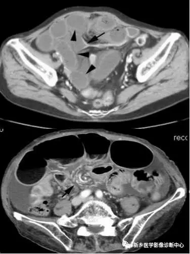弹簧|图解21种腹部疼痛原因