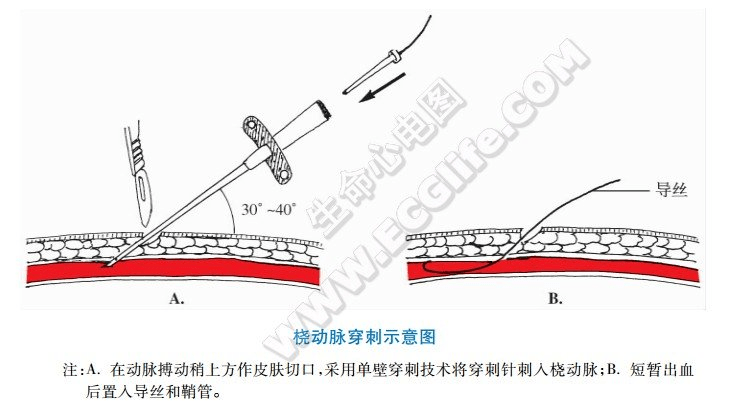 點加壓止血便橈動脈穿刺全腦血管造影術相比於傳統的經皮股動脈穿刺