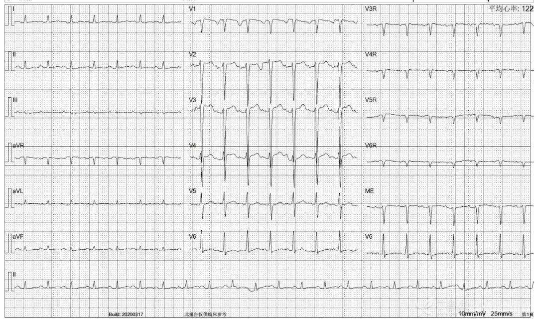 avr心电图常见形态图片