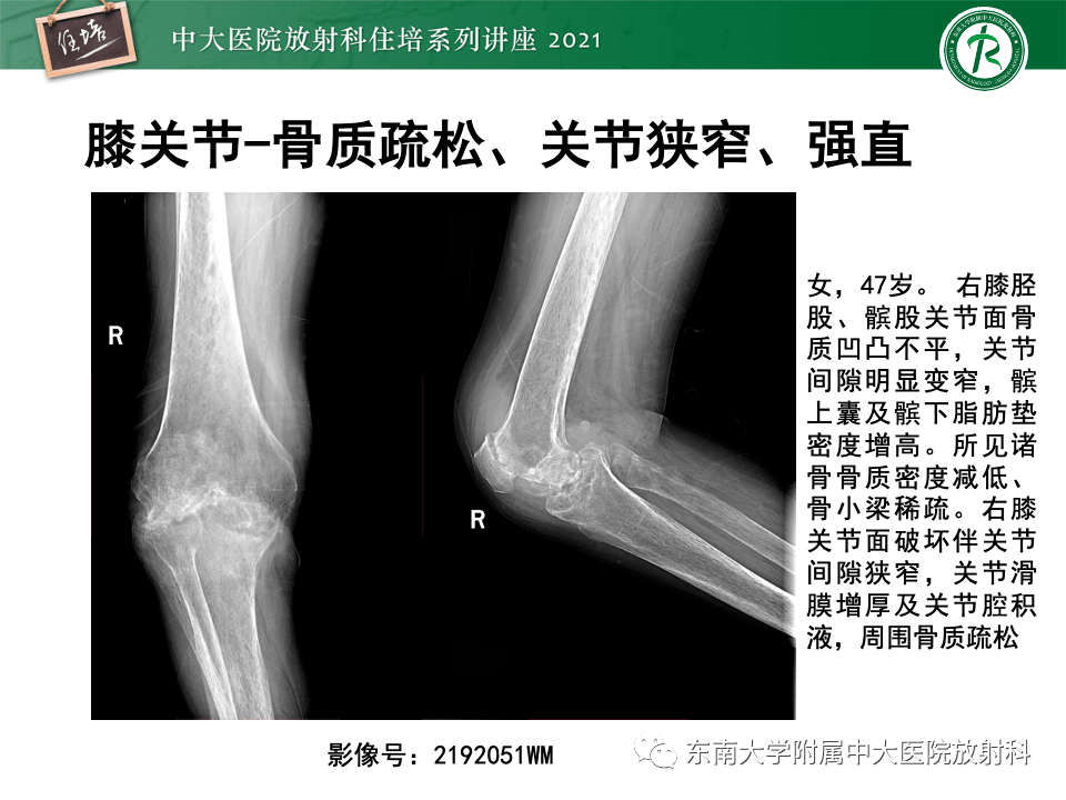 類風溼關節炎的影像學診斷