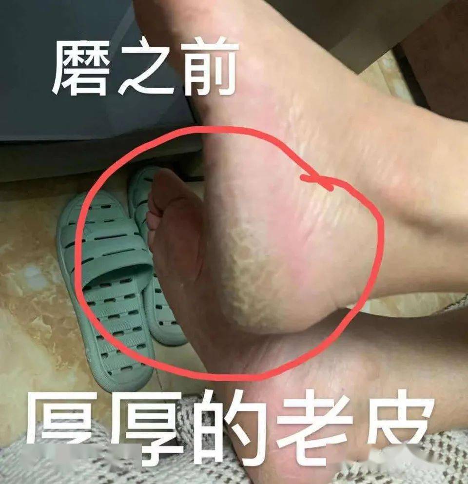 当然不止脚掌, 常年摩擦的脚趾, 脚背,还有手掌,胳膊肘