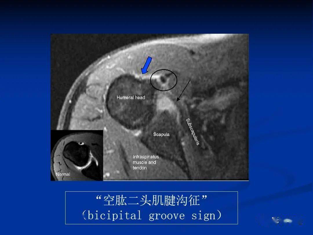 肩袖解剖及損傷的臨床及mri診斷